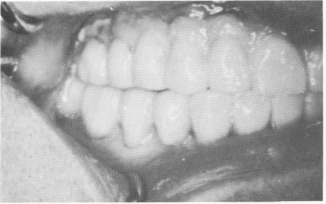 3 Gold occlusal stops to slow occlusal wearing down of the acrylic