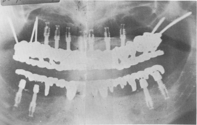 1 Panorex showing seven ventplants, triplant, and biplant