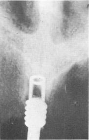 2 Internally threaded ventplant screwed into maxillary process
