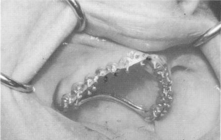 3 Maxillary scalloped template secured to ventplant by set screw