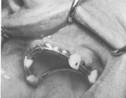 1 Dental pin implants secured with acrylic cores