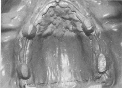 2 Maxillary full arch rubber base impression 