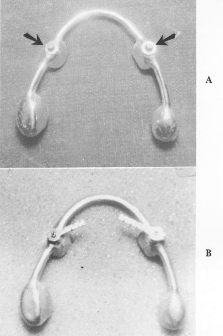 3 Superstructure with gold copings connected with connecting bar