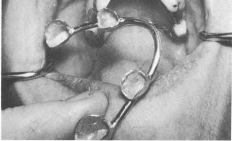 4 Female & male attachments over each other on dental prosthesis