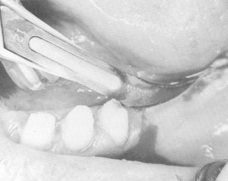 1 Incising the tissue before dental bladevent insertion 