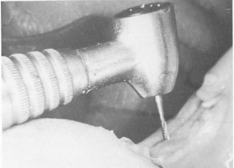 2 Making the groove for dental bladevent insertion 