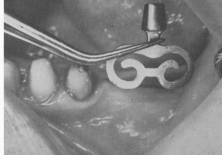 4 Same size groove as dental implant in mesiodistal relationship