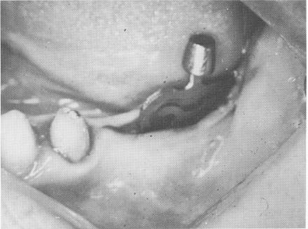 5 Dental implant placed inside the groove