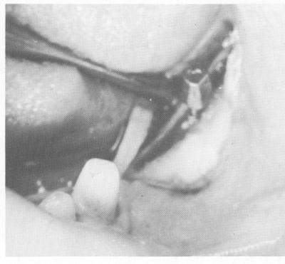 1 Dental blade implant tapped using mallet & inserting instrument 