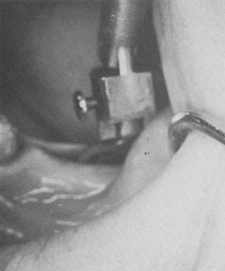 2 Oral bladevent shoulder is 1 to 2 mm. beneath the cortical plate