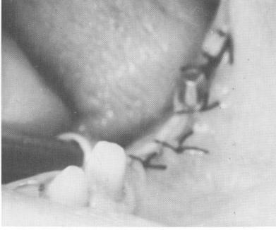 3 Oral bladevent placed & site closed with simple surgical ties