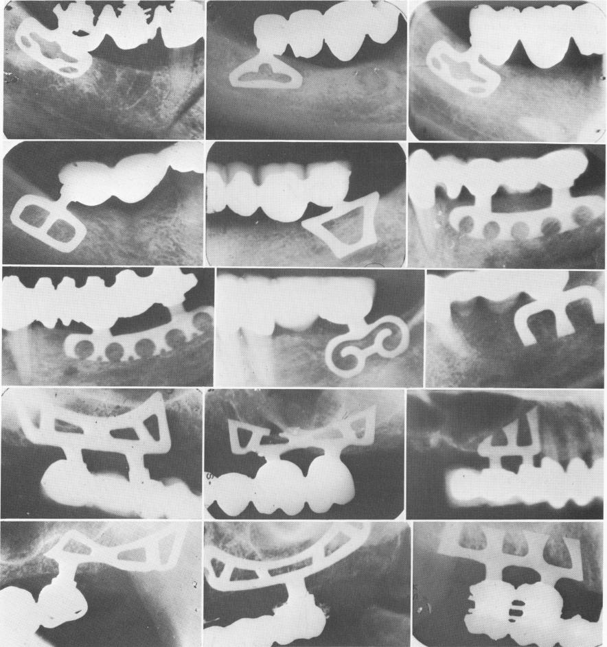 1 Dental Blade implants for free end saddle areas