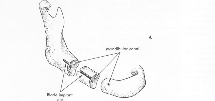 1 Groove made buccally to the mandibular canal for bladevent placement