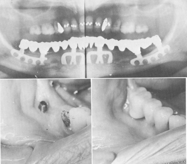 2 Right posterior implant set buccally to the mandibular canal