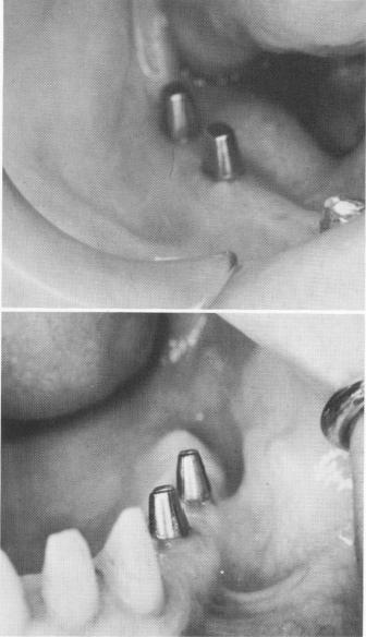 1 Soft tissues heal more firmly around posts of dental blade implants 