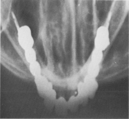 2 X ray shows suitability of dental blade implant for knife edge ridges