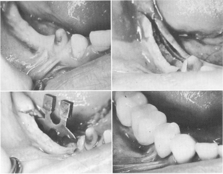 1 Mandibular ridge with anterior prepared tooth