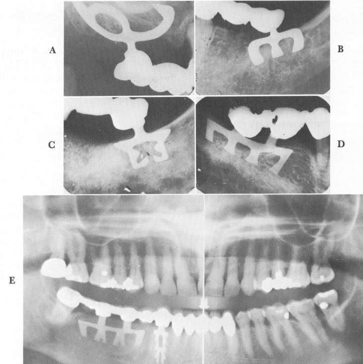2 For dense bone apical end of dental blade should be open