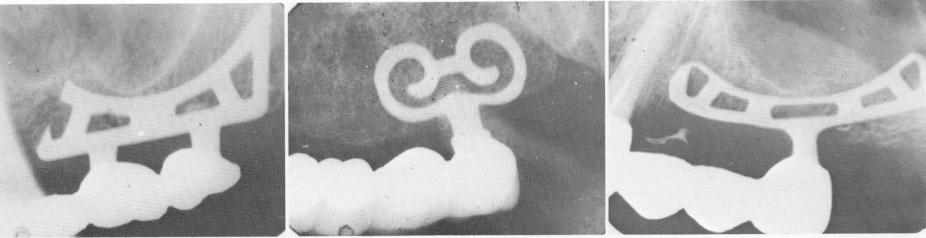 1 Dental blades with more secondary struts used in porous areas