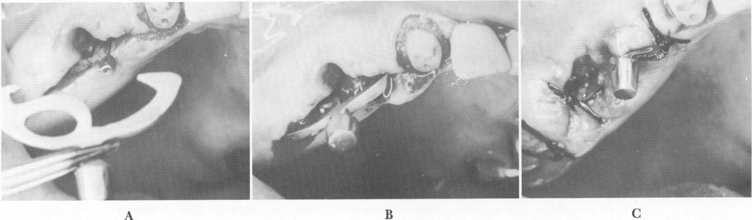 2 Dental blade implant for open socket