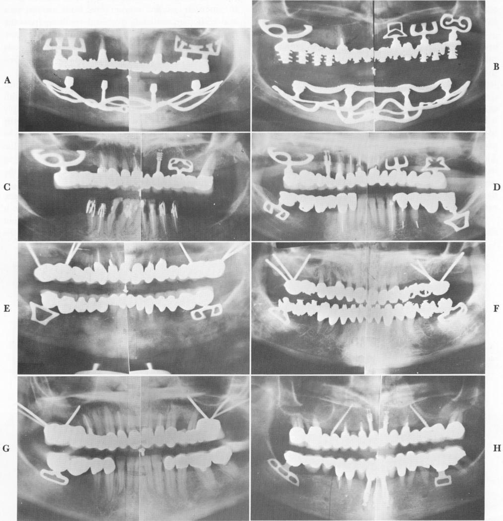 1 Mixed mandibular and maxillary endosseous implants
