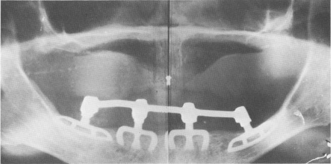 1 Four mandibular blades splinted with connecting bar mesostructure