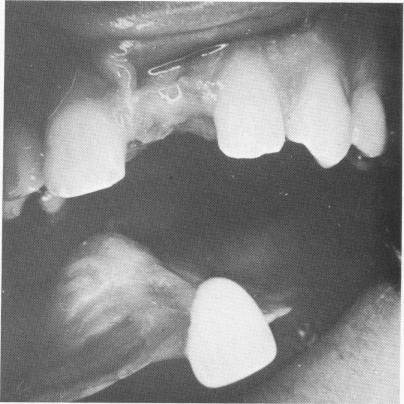 2 Left maxillary central incisor restored with removable prosthesis