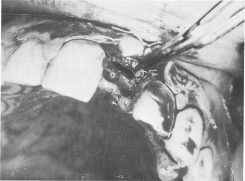 2 Deep groove made in maxillary bone for bladevent insertion