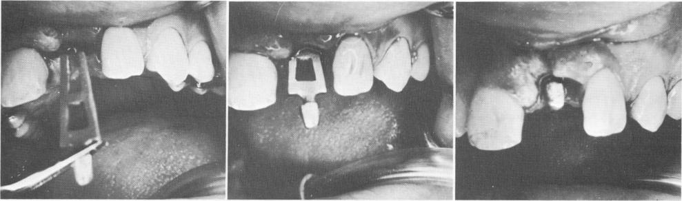 3 Pictures showing insertion of blade implant in upper jaw