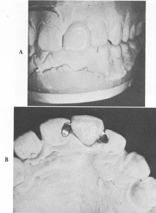 1 Maxillary labial view showing overlapping of interproximal surface