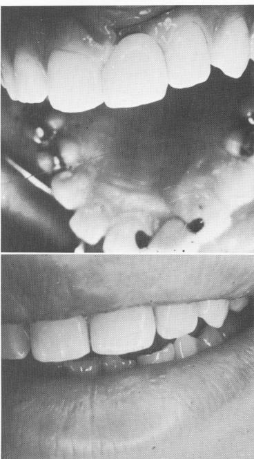 2 Maxillary crown fabricated with lingual gold rest seats