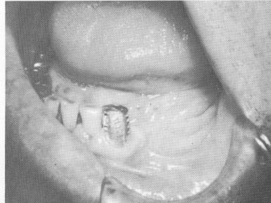 3 Postoperative x ray showing single tooth restoration by bladevent
