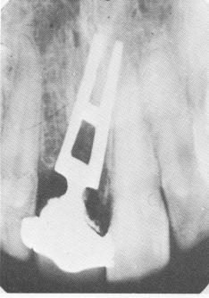 4 Cuspid casting over mandibular tooth preparation