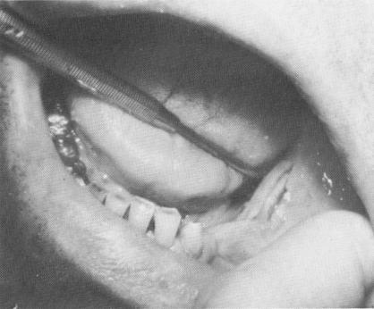 1 Groove made at mandibular implant site for bladevent