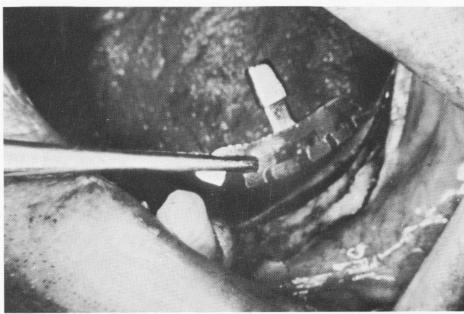 2 Bladevent set in prepared mandibular groove