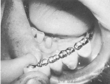 3 Fixed mandibular partial denture ready for cementation on bladevent