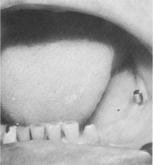 4 Radiograph showing unilateral mandibular restoration by blade implants