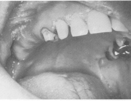 1 Edentulous site in maxilla for blade placement