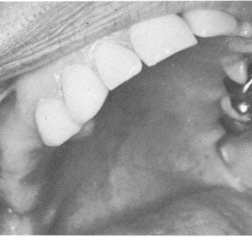 2 Maxillary anterior teeth prepared for full crown restoration