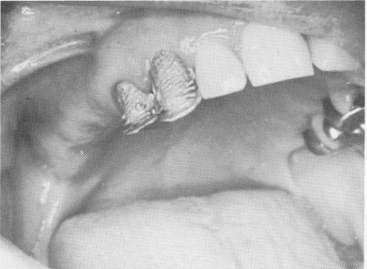 3 Dies placed on maxillary master stone cast