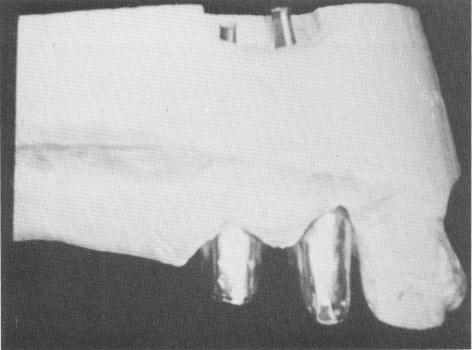 4 Castings over prepared maxillary abutment teeth