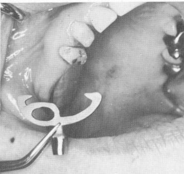 1 Blade implant placed into prepared maxillary groove