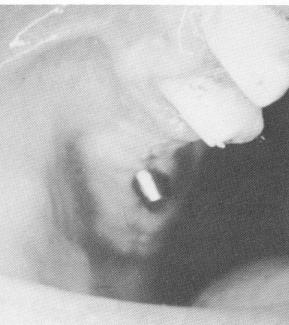 2 Completed unilateral maxillary posterior prosthesis over blades