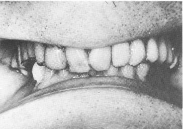 2 Dental blade implants avoiding maxillary sinuses