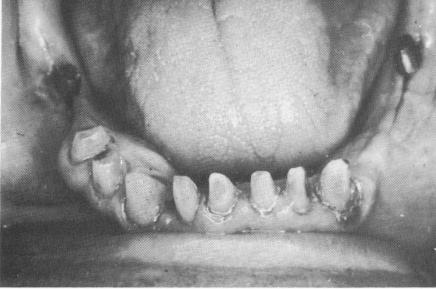 1 Picture showing mandibular implants seated