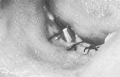 2 Double posted blade implant used in maxilla