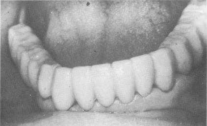 3 Final maxillary restoration over double posted blade implant