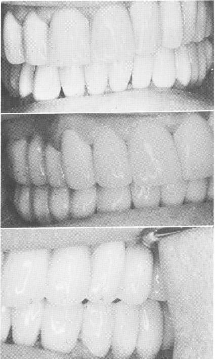1 Bilateral mandibular & unilateral maxillary restoration finished case