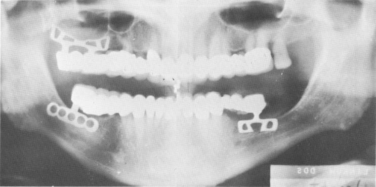 2 Panorex showing mandibular & maxillary bladevents in bone 
