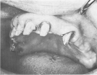 1 Maxillary teeth prepared for full crown restorations